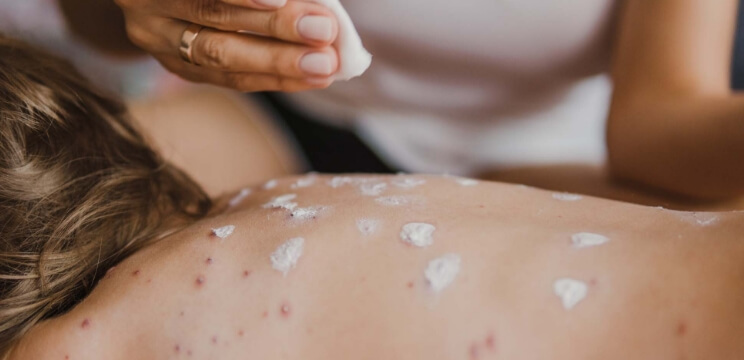 Bild - Går det att undvika vattkoppor?