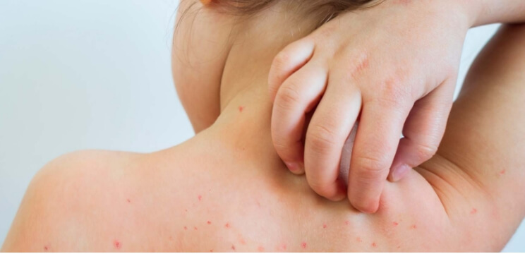 Bild - Hur smittar vattkoppor?